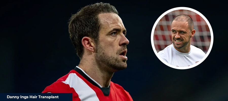 Danny Ings Hair Transplant