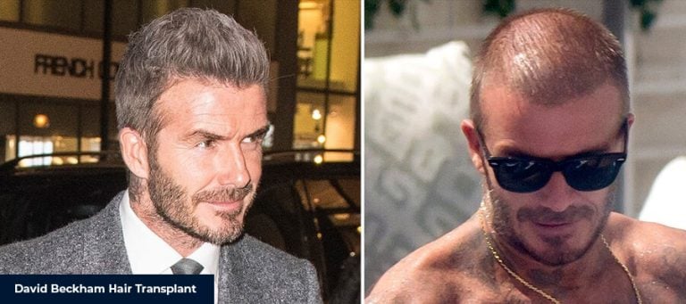 David Beckham Saç Ekimi