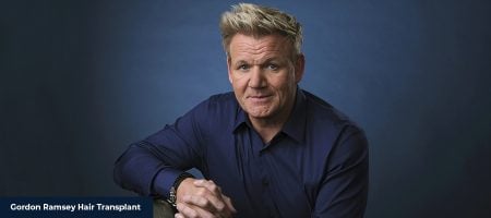 Gordon-Ramsey-Hair-Transplant-03