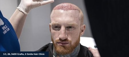 HAIR-TRANSPLANT-SIDE-EFFECTS