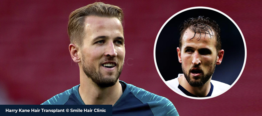 Harry Kane Hair Transplant