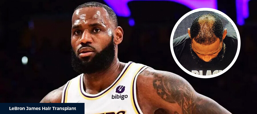 LeBron James Hair Transplant
