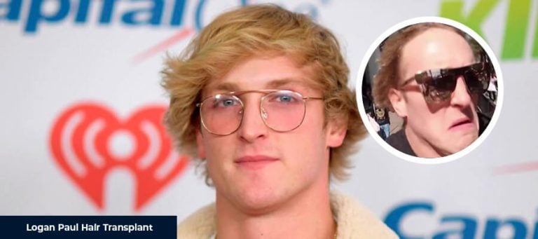Logan Paul Saç Ekimi