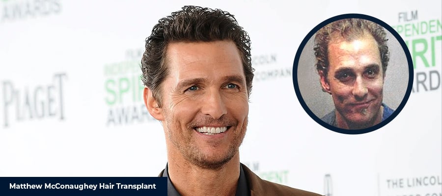 Matthew McConaughey Hair Transplant