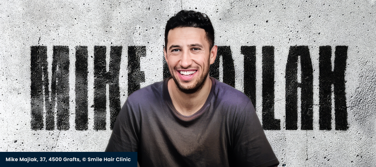 HeyBigMike Here for a Hair Transplant