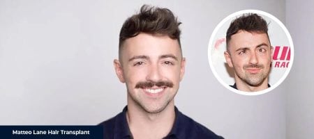 Matteo-Lane-Hair-Before-After