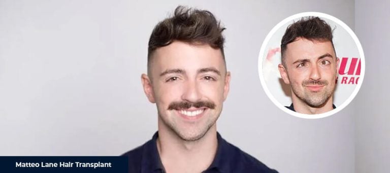 Matteo Lane Saç Ekimi