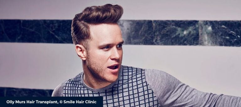 Olly Murs Saç Ekimi