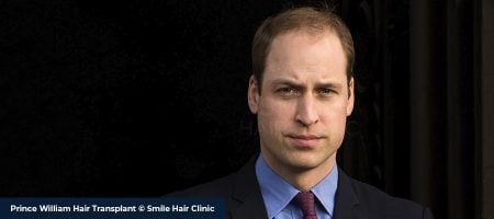 Prince-William-Hair-Transplant-3