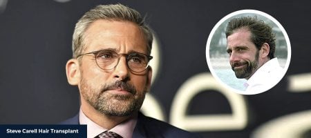 STEVE-CARELL-HAIR-TRANSPLANT-1