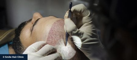 Sapphire-Hair-Transplant-1