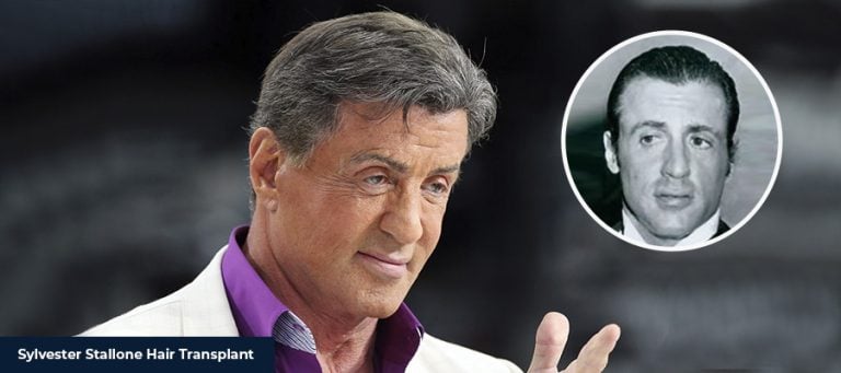 Il Trapianto di Capelli di Sylvester Stallone