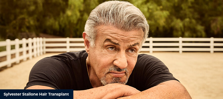 Sylvester Stallone Saç Ekimi