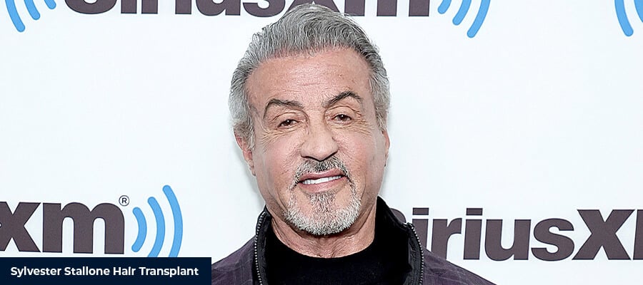 Sylvester Stallone Saç Ekimi
