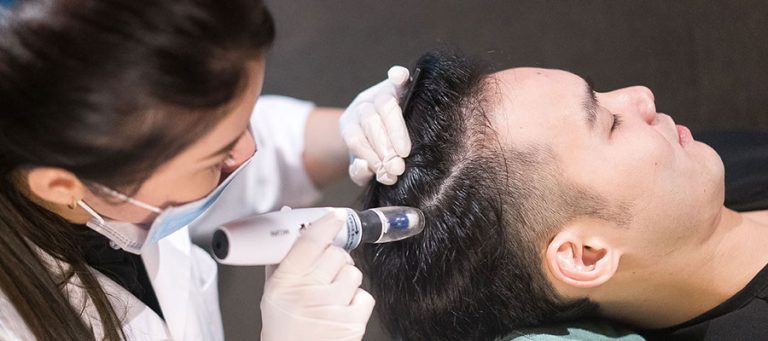 TRAITEMENT DES CHEVEUX AVEC LA MESOTHERAPIE