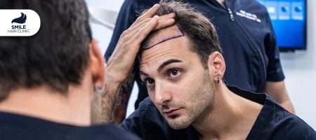 What-To-Expect-From-A-Hair-Transplant