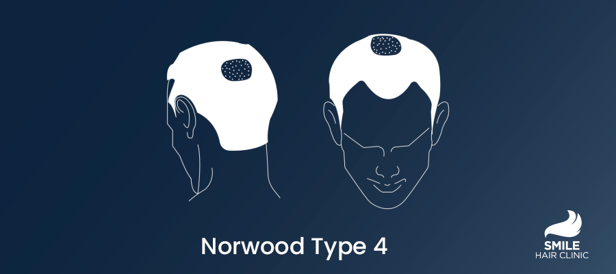Norwood Type 4 Hair Loss