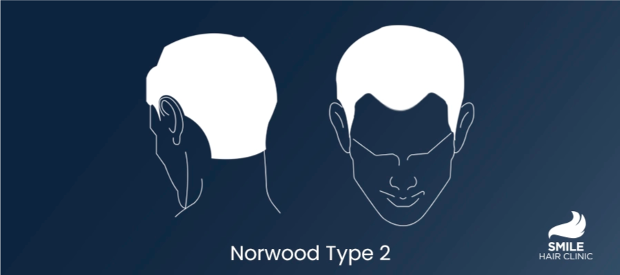 Norwood Type 2 Hair Loss