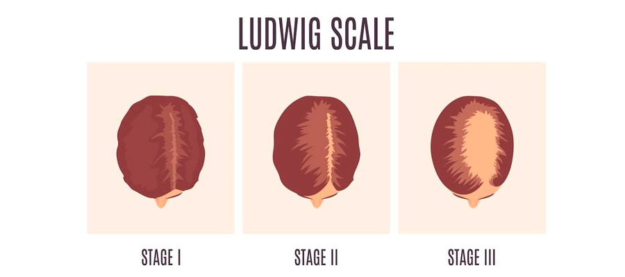 Female Hair Loss: Causes, Diagnosis, and the Most Effective Treatments