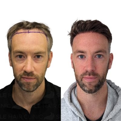 3000 Grafts - ROSS STEVEN ROY