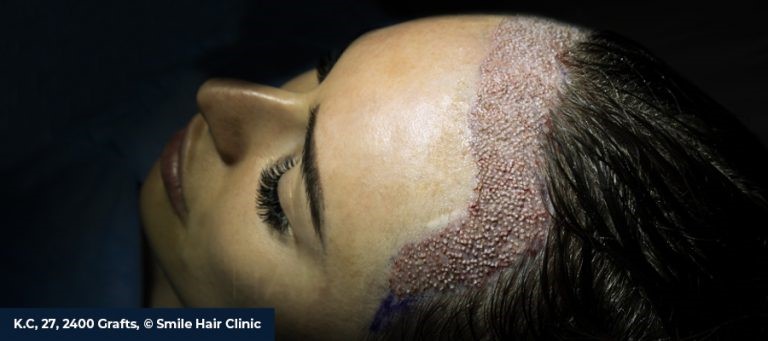 Female Hair Loss: Causes, Diagnosis, and the Most Effective Treatments