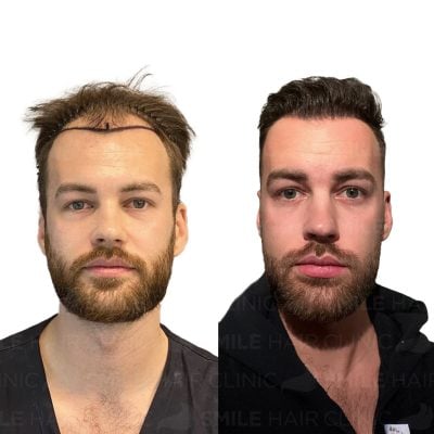 3300 Grafts - ALEXANDER ROSENER