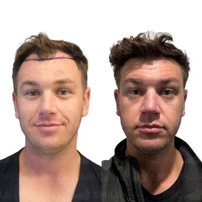 3500 Grafts - GAVIN WILD