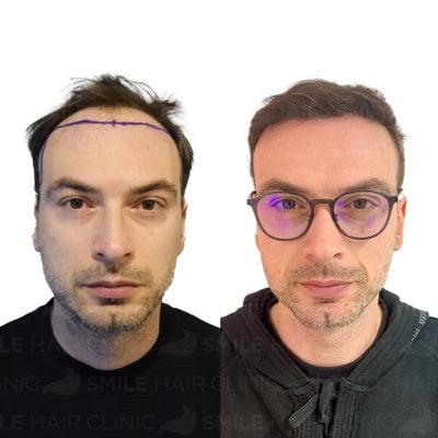 3500 Grafts - PANAGIOTIS GERONTOPOULOS