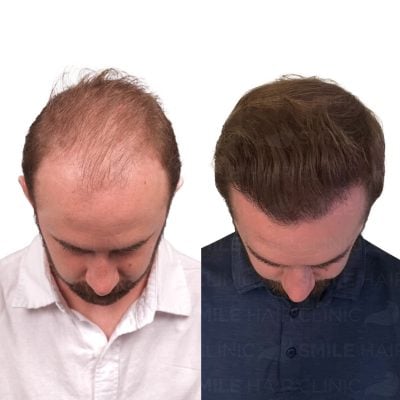 3500 Grafts - RYAN ANDRES POSADA