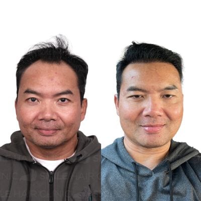 3500 Grafts - YUDHA HERMAWAN