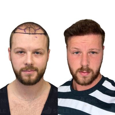 3650 Grafts - RHYS STROULGER