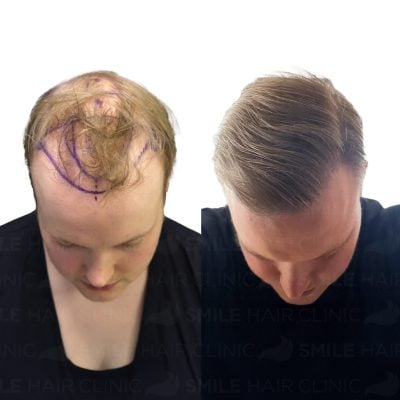 3800 Grafts - JOACHIM LEHMANN ERIKSEN