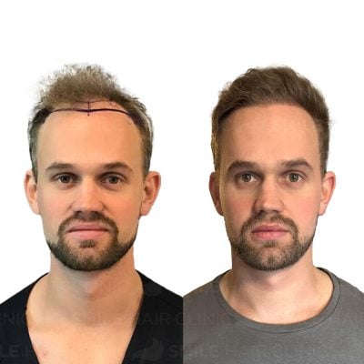 3900 Grafts - SANDER LINDGUIST