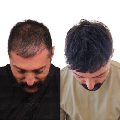 4000 Grafts - CANER SAHIN