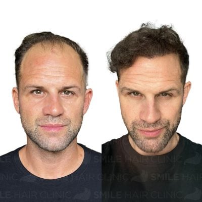 4100 Grafts - AURY BARNETT