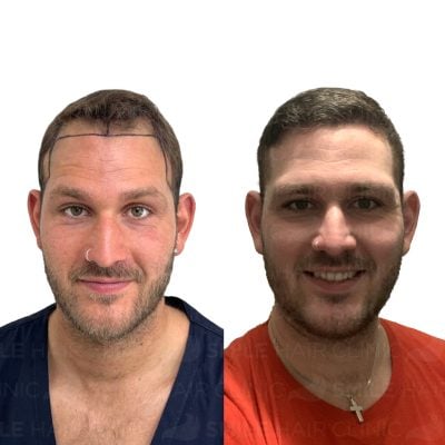 4300 Grafts - ADAM NUNN