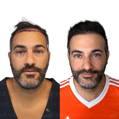 4500 - Grafts - AMIR OWLIAEI