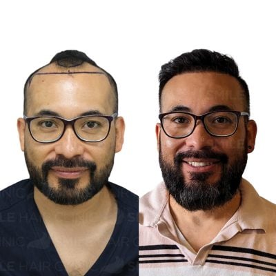 4500 Grafts - FERNANDO DE LEON