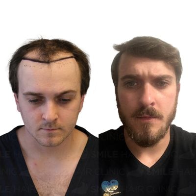 4700 Grafts - RICHARD LEE HEISE