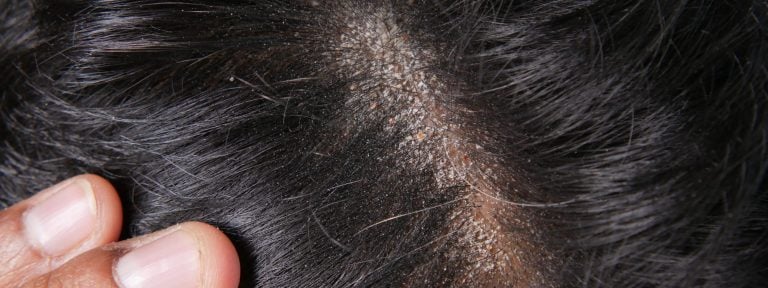 Haartransplantation Narbe – Auf Narbe Haare transplantieren?