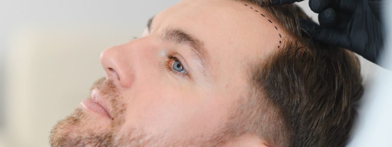 Haartransplantation Risiken: Worauf man achten sollte