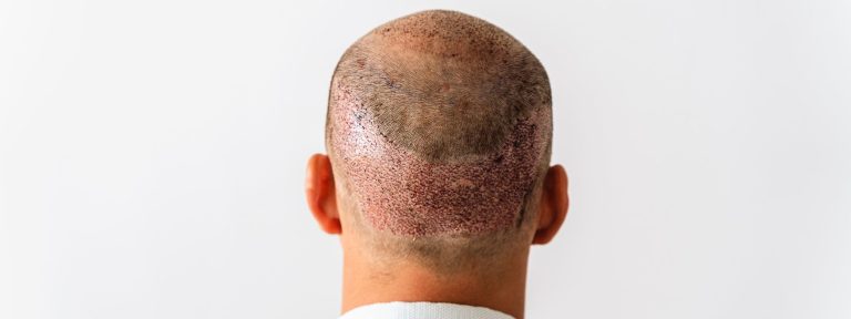 Haartransplantation: Woher Haare? Haarkranz und BHT