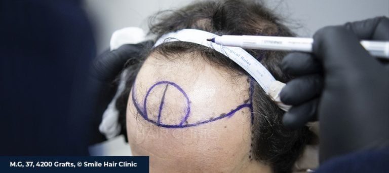 Norwood-Hamilton Scale