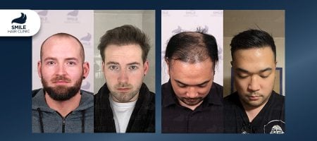 Should-I-have-my-hair-transplant-in-Turkey