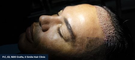 Unshaven-Hair-Transplant-02 (1)