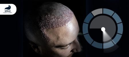 What-is-the-success-rate-of-hair-transplant-in-Turkey-