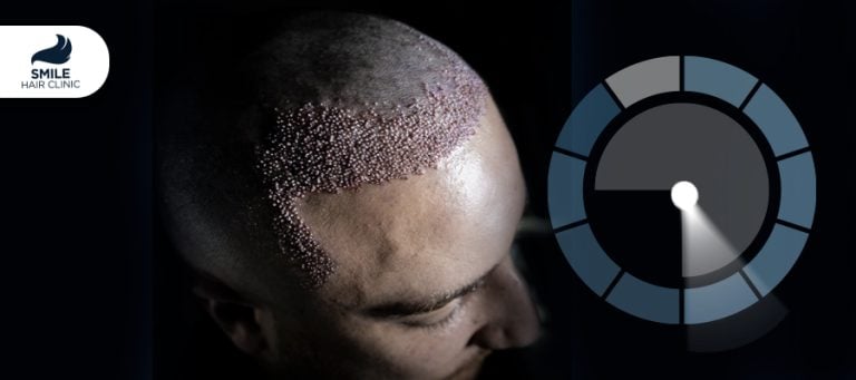 What is the success rate of hair transplants in Turkey?