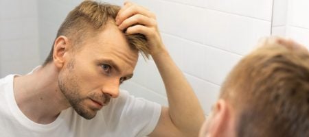 ab-welchem-Alter-Haartransplantation-2000x750