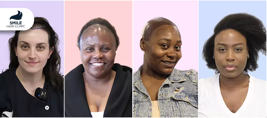 Perte de Cheveux chez la Femme : Causes, Diagnostic et Traitements Efficaces