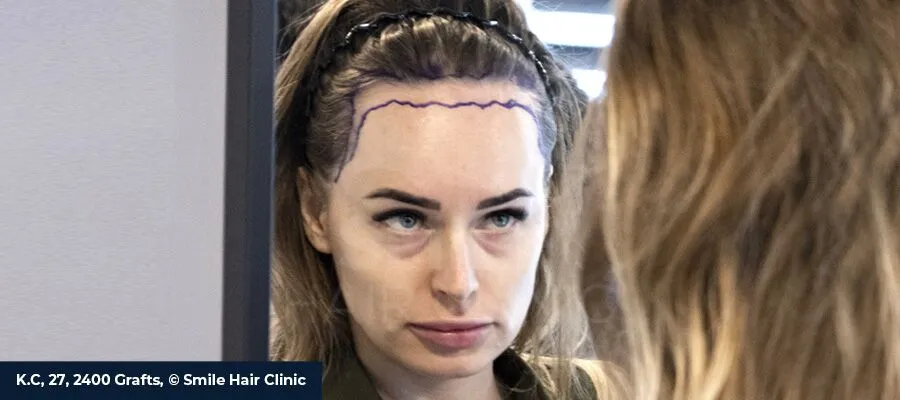 Female Hair Loss: Causes, Diagnosis, and the Most Effective Treatments